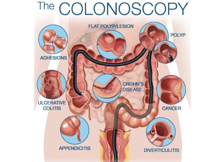 Colonoscopy Treatment in Mohali| Livasa Hospitals