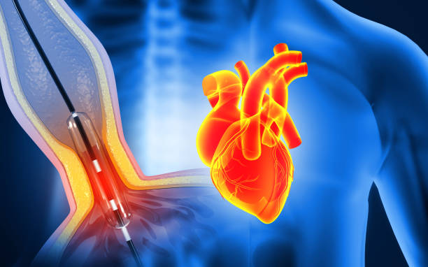 Angioplasty Surgery Cost in Mohali: Stent Types, Packages & EMI Options