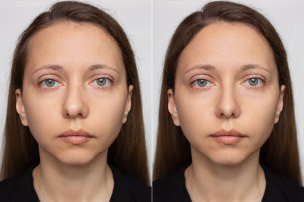 ENT + Cosmetic in Mohali: Septoplasty for Breathing with Cosmetic Rhinoplasty Offers